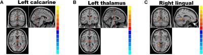 Alterations in the Brain Structure and Functional Connectivity in Aquaporin-4 Antibody-Positive Neuromyelitis Optica Spectrum Disorder